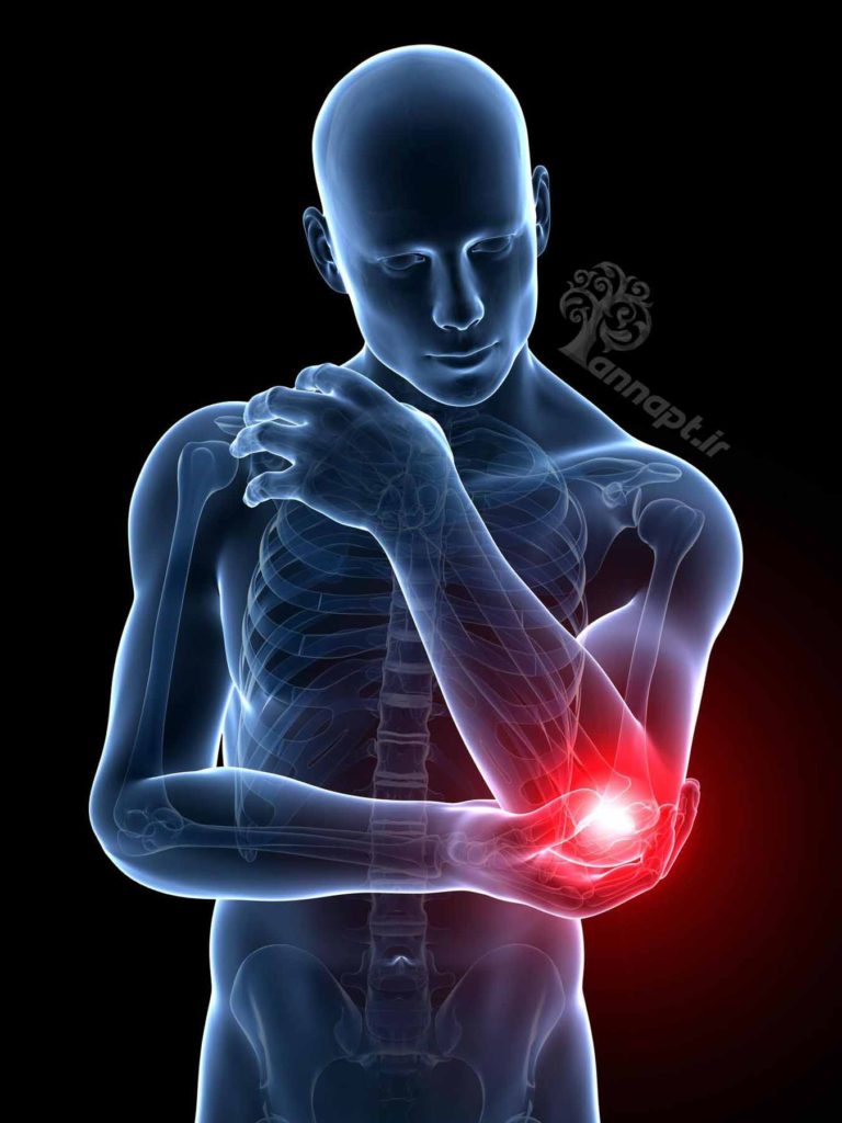 آرنج ، درد آرنج ، فیزیوتراپی آرنج ، تنیس البو