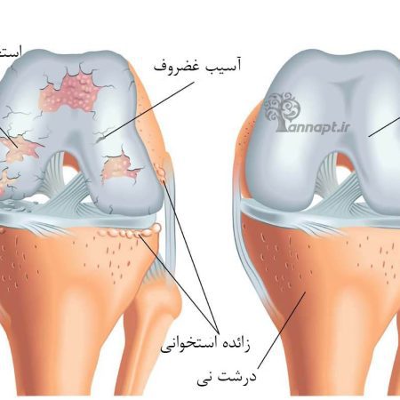 آرتروز زانو ، زانو درد ، آسیب زانو ، درد زانو ،ساییدگی مفصل زانو ، غضروف زانو علائم آرتروز زانو
نشانه های آرتروز زانو چیست؟
علائم و نشانه های ابتلا به آرتروز زانو ممکن است شامل یک یا همه موارد زیر باشد :
بروز درد و سوزش در زانو : سوزش و درد در ناحیه زانو از مهمترین نشانه های آرتروز زانو است. این درد معمولاً ممکن است در فعالیتهای روزمره مانند بالا پایین رفتن از پله ، پیاده روی ، نشستن و برخاستن از روی صندلی خصوصاً در اتومبیل و حتی در حین استراحت یا شب هنگام احساس شود. میزان و شدت درد ممکن است در شبانه روز افزایش یا کاهش یابد.
محدودیت حرکت زانو : آرتروز زانو میتواند منجر به محدودیت و سفتی حرکت زانو شود. افراد ممکن است نتوانند زانو را به طور کامل خم کنند یا صاف کنند.
صداهای مفصل زانو : تق تق ، خش خش ، یا صداهای مفصلی ممکن است هنگام حرکت زانو ایجاد شود. این صداها معمولاً ناشی از تماس میان سطوح استخوانی با یکدیگر به دلیل تخریب کارتیلاژ مفصلی هستند.
ورم و التهاب در زانو : در زانو ممکن است تورم و التهاب احساس شود که این وضعیت به عنوان آرتریت مفصلی نیز شناخته می گردد.
ضعف عضلات زانو : به دلیل درد و محدودیت در حرکت ، عضلات پیرامونی زانو ممکن است ضعیف شوند. این ضعف میتواند به تشدید مشکلات زانو نیز منجر شود.
تغییر در شکل زانو : در مراحل پیشرفته تر آرتروز زانو ، ممکن است زانوهای شما شکلهای غیرطبیعی به خود بگیرند.
سرخی یا داغ شدن زانو : پوست نواحی زانو ممکن است در نتیجه التهاب و آرتریت مفصلی گرم و قرمز رنگ شود.
افت فعالیت در افراد : به علت درد و محدودیت در حرکت ، افراد ممکن است دیگر نتوانند مثل گذشته تحرک داشته و در نهایت فعالیتهای روزمره خود را کاهش می دهند.
نوع و شدت علائم آرتروز زانو ممکن است بین افراد مختلف متفاوت باشد.