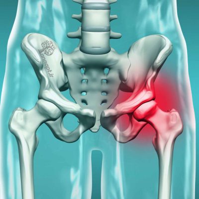 آرتروز لگن ، آرتروز مفصل لگن ، درمان لگن ، درمان مفصل لگن ، pelvic pain ، pelvic physiotherapy آرتروز لگن ، آرتروز مفصل لگن ، درمان لگن ، درمان مفصل لگن ، pelvic pain ، pelvic physiotherapy