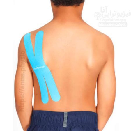 طیف بیماری های قابل درمان با تیپ

تیپ به شکل حرف (X) لاتین
تیپ به شکل (X) چه کاربردی دارد :

این نوع از تیپ زدن به شکل ضربدری برای مورد زیر کاربرد دارد :

مبدا و محل تلاقی عضله هدف بسته به حرکت تغییر می کند ، به عنوان مثال. رومبوئیدها