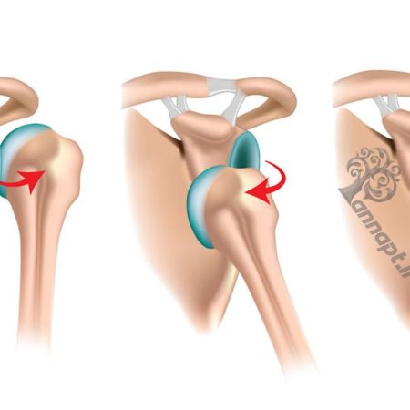 دررفتگی شانه ، درد شانه ، فیزیوتراپی شانه دررفتگی شانه ، درد شانه ، فیزیوتراپی شانه