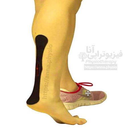 انواع تیپ کینزیولوژی
انواع مختلف بستن تیپ در فیزیوتراپی کدامند؟
تیپ به شکل حرف (]) لاتین
تیپ به شکل (I) چه کاربردی دارد :

این نوع از تیپ بستن به شکل دمبل در موارد زیر کاربرد دارد :

آسیب حاد
ادم و درد
بهبود پاسچر